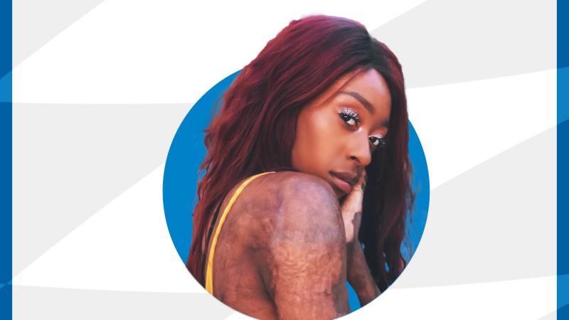 IPC branded graphic with photo of Black female showing burns scars on arm 
