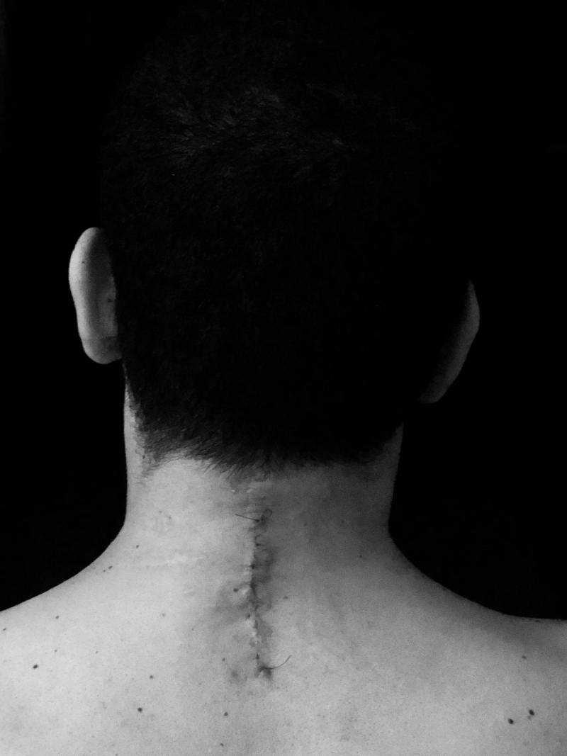 Neck surgery